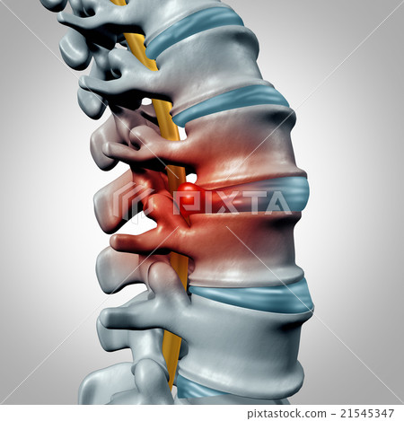 Herniated Disk Herniated Disk 21545347