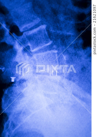 Spine back metal implant xray scan Spine back metal implant xray scan 21621097