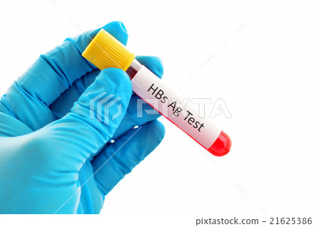 HBsAg (hepatitis B virus) test 21625386