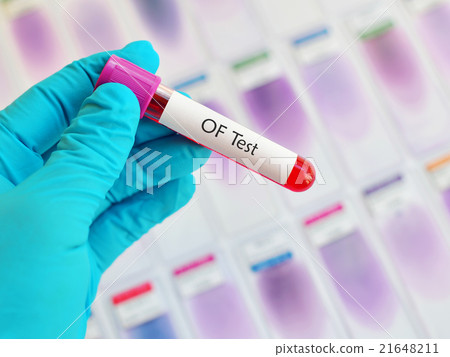 Stock Photo: Osmotic Fragility (OF) test