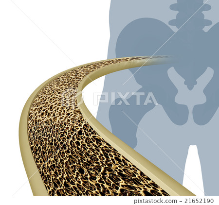 Osteoporosis Medical Illustration Osteoporosis Medical Illustration 21652190