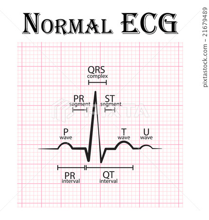 Normal ECG ( Electrocardiogram )  21679489