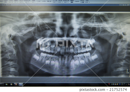 牙齒數字X光片 21752574