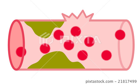 Blood vessel - Stock Illustration [21817499] - PIXTA