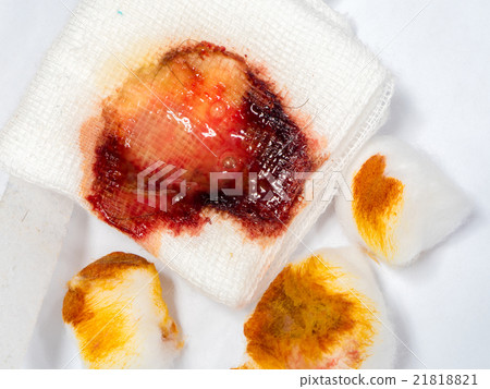 Stain of pus, blood and anti-bacterial 21818821