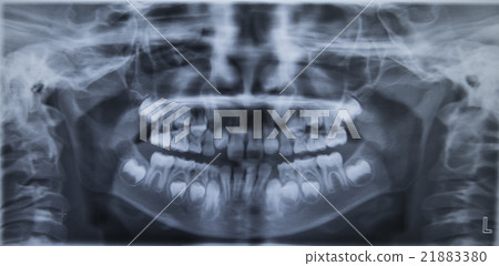Tooth digital radiograph 21883380