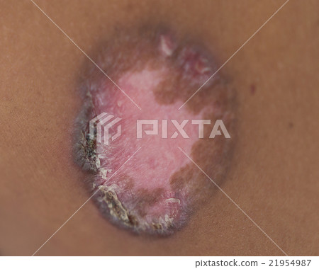 Skin disorder 21954987