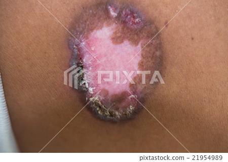 Skin disorder Skin disorder 21954989