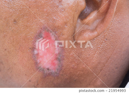 Skin disorder Skin disorder 21954993