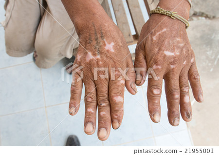 Skin disorder Skin disorder 21955001