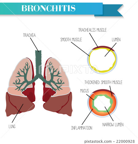 Healthy and inflamed bronchus. Chronic Bronchitis. 22000928