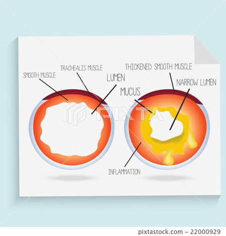 Normal lumen of the bronchus and bronchus Normal lumen of the bronchus and bronchus 22000929