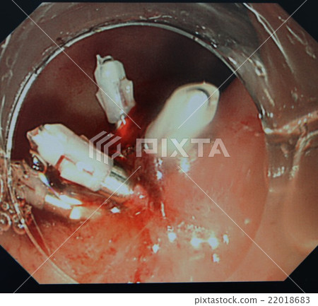 Duodenal ulcer 22018683