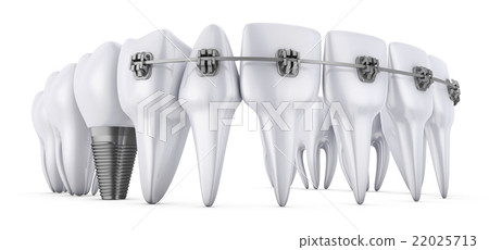 teeth and implant teeth and implant 22025713