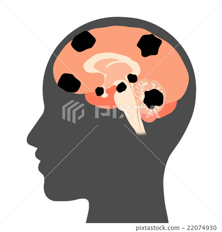 Brain tumor 22074930