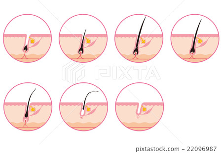 Hair Removal Hair Cycle Hair Cycle 22096987