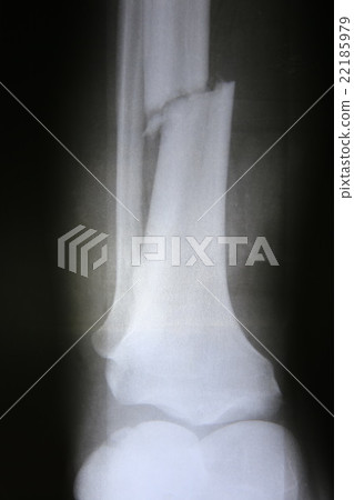 X-ray photos of fracture patients X-ray photos of fracture patients 22185979