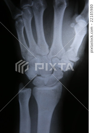 X-ray photos of bone fracture patients 22185980