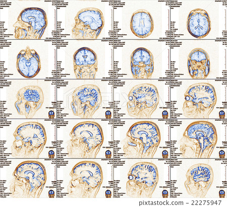 Magnetic resonance imaging of the brain Magnetic resonance imaging of the brain 22275947