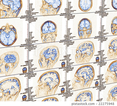 Magnetic resonance imaging of the brain Magnetic resonance imaging of the brain 22275948