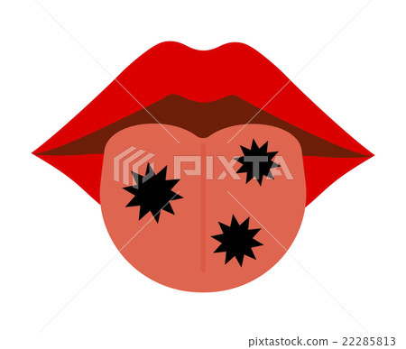 Fungus adhered to the tongue 22285813