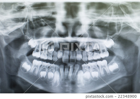 牙齒數字X光片 牙齒數字X光片 22348900