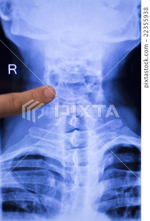 Spine back neck xray scan 22355938