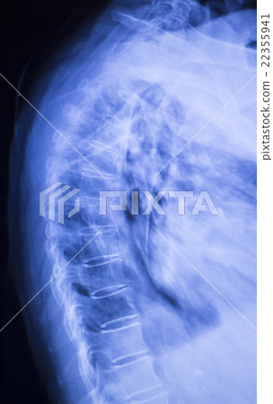 Spine back neck xray scan 22355941