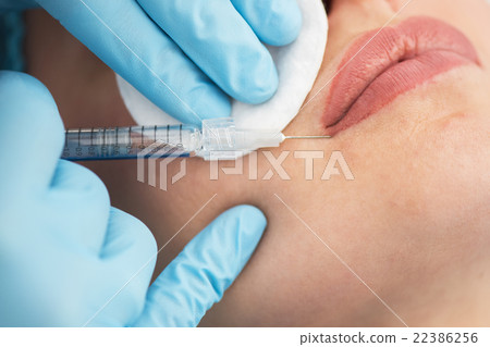 woman gets injection in her lips 22386256