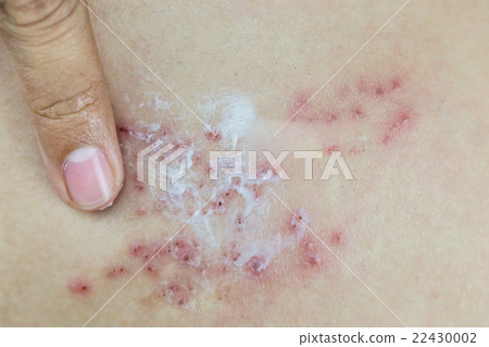 Raised red bumps and blisters on skin Raised red bumps and blisters on skin 22430002