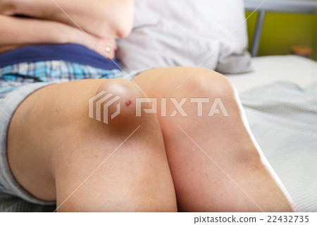 Female injured knee, close up 22432735