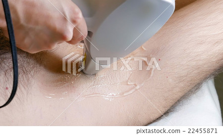 Man gets laser hair removal treatment underarm 22455871