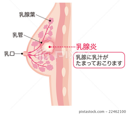 Chest cross-section mastitis 22462100