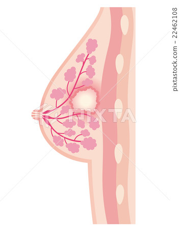 Chest cross-section mastitis Chest cross-section mastitis 22462108