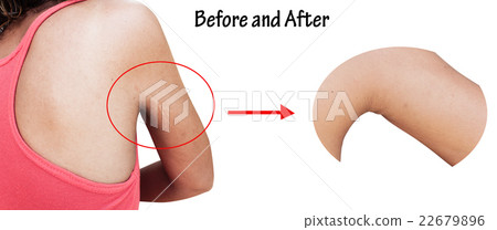 before, after scratch mark and wrinkle of armpit 22679896