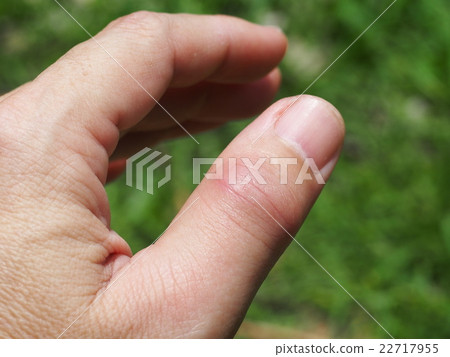 left thumb finger joint pain, gout, rheumatoid 22717955