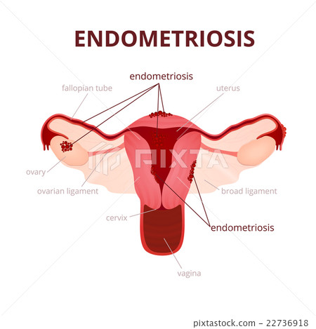 Endometriosis in the uterus 22736918