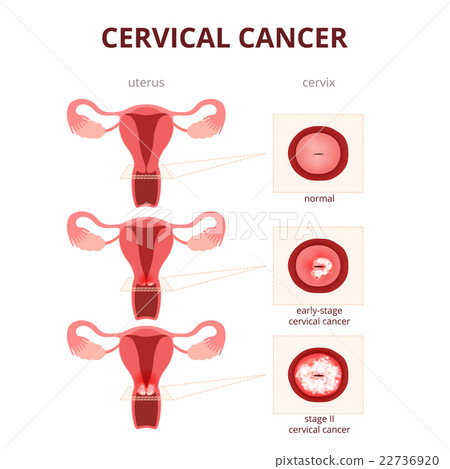 cervical cancer schematic illustration 22736920