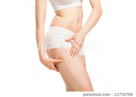 Woman with outlines for plastic surgery on body 22750768