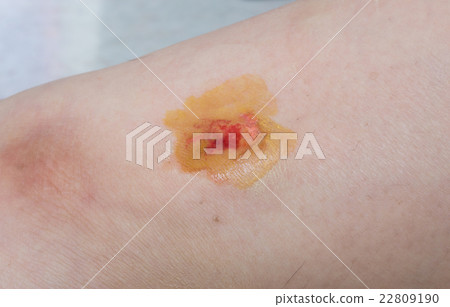Wound on woman leg 22809190