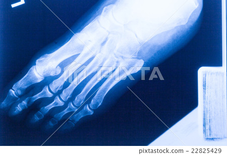 Ankle feet & knee joint X-ray human photo film Ankle feet & knee joint X-ray human photo film 22825429