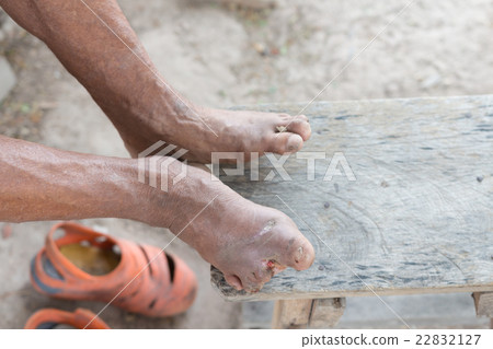 Hansen's disease 22832127