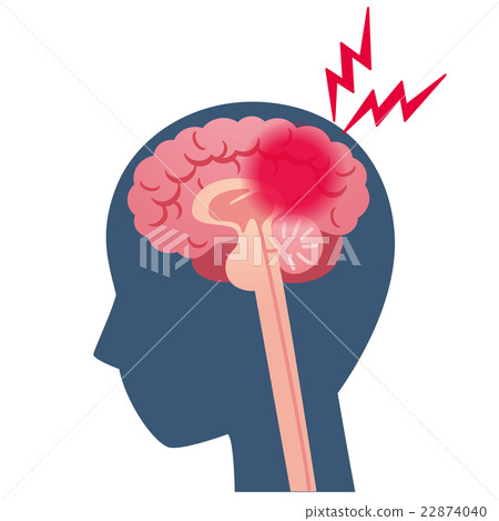 Headache cerebral infarct disease of the brain 22874040