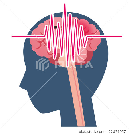 腦部頭痛腦梗塞病 22874057