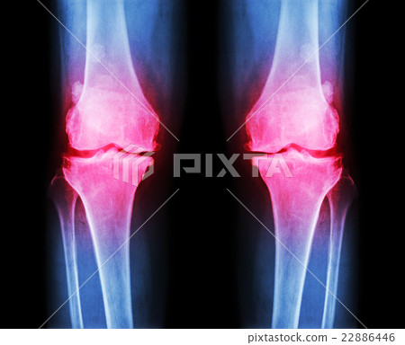 Osteoarthritis both knee 22886446