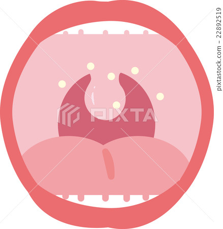 Mouth sores 22892519