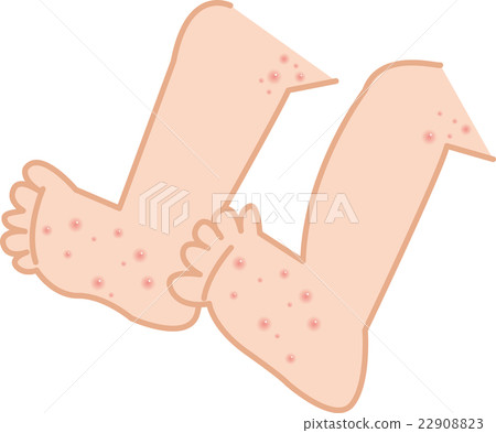 Hand & foot mouth disease foot uneven rash 22908823