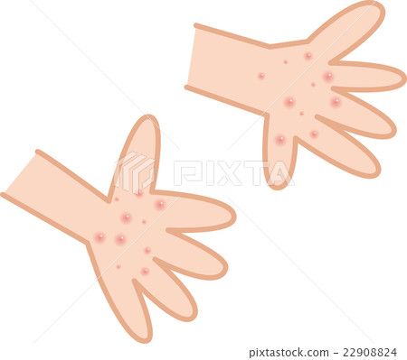 手足口病掌疹 22908824