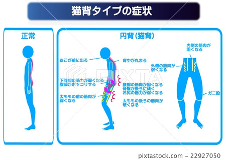 Stalk back (round back) type Symptoms spine Stalk back (round back) type Symptoms spine 22927050