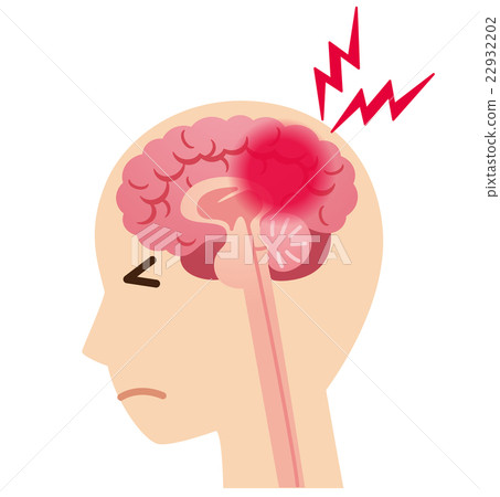 Headache cerebral infarct disease of the brain 22932202